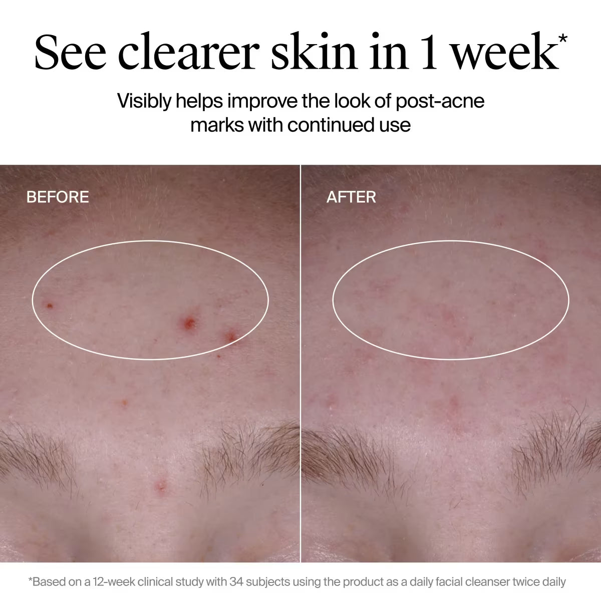 Neutrogena® Evenly Clear™ Acne Cleanser, 9.1 Oz - US 4397