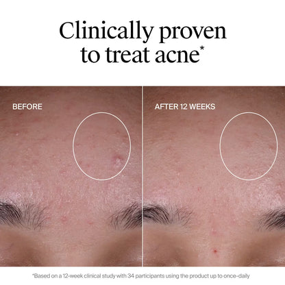 Neutrogena® Evenly Clear™ Acne Exfoliant, 1 fl oz - US 3768